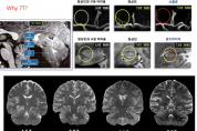 뇌전용 MRI7.0 유치로 전국 최초 뇌질환 전문도시[제안]